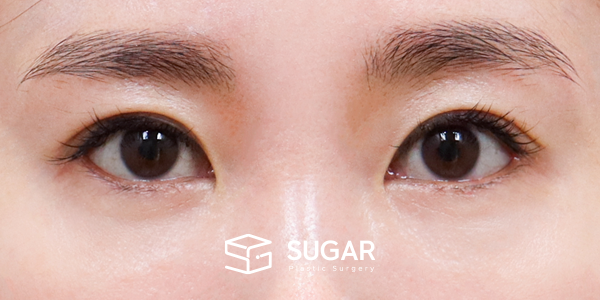 SUGAR整形外科 術前術後案例 #1270 術前術後照片 - 術後