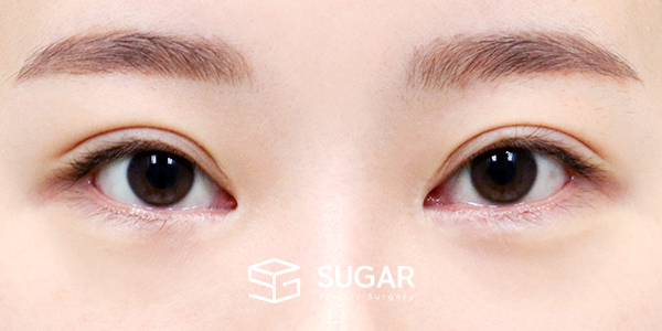 SUGAR整形外科 術前術後案例 #1443 術前術後照片 - 術前
