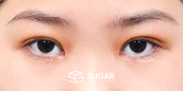 SUGAR整形外科 術前術後案例 #1201 術前術後照片 - 術後
