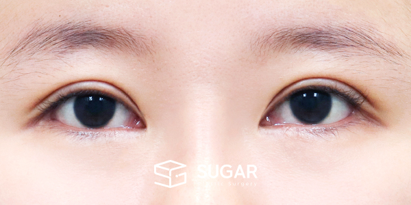 SUGAR整形外科 術前術後案例 #1442 術前術後照片 - 術前