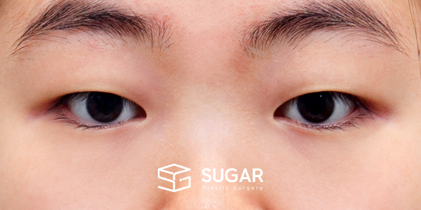 SUGAR整形外科 術前術後案例 #1177 術前術後照片 - 術前