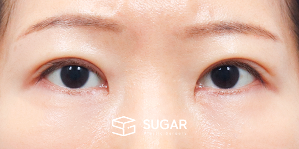 SUGAR整形外科 術前術後案例 #1173 術前術後照片 - 術後