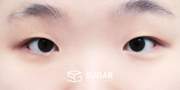 SUGAR整形外科 術前術後案例 #1453 術前術後照片 - 術前