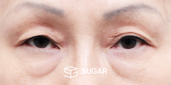 SUGAR整形外科 術前術後案例 #1450 術前術後照片 - 術前