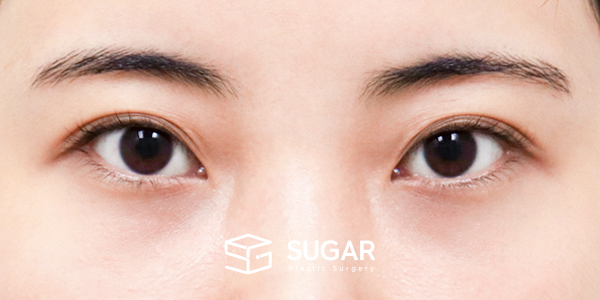 SUGAR整形外科 術前術後案例 #1274 術前術後照片 - 術前