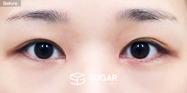 SUGAR整形外科 術前術後案例 #1458 術前術後照片 - 術前