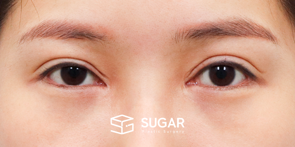 SUGAR整形外科 術前術後案例 #1262 術前術後照片 - 術前