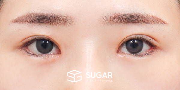 SUGAR整形外科 術前術後案例 #1263 術前術後照片 - 術後