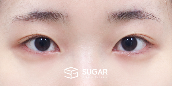 SUGAR整形外科 術前術後案例 #1176 術前術後照片 - 術前