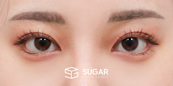 SUGAR整形外科 術前術後案例 #1209 術前術後照片 - 術後