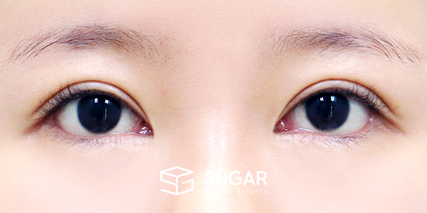 SUGAR整形外科 術前術後案例 #1442 術前術後照片 - 術後
