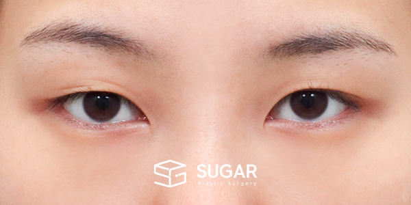 SUGAR整形外科 術前術後案例 #1280 術前術後照片 - 術前