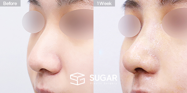SUGAR整形外科 術前術後案例 #1466 術前術後照片 - 45度術前術後比較