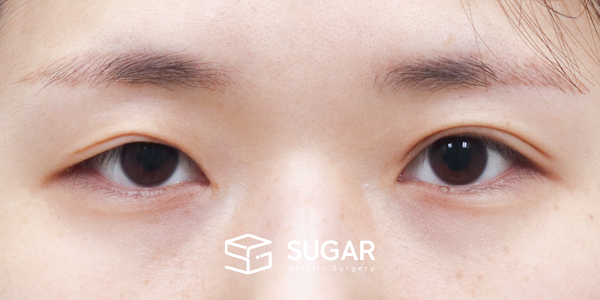 SUGAR整形外科 術前術後案例 #1205 術前術後照片 - 術前