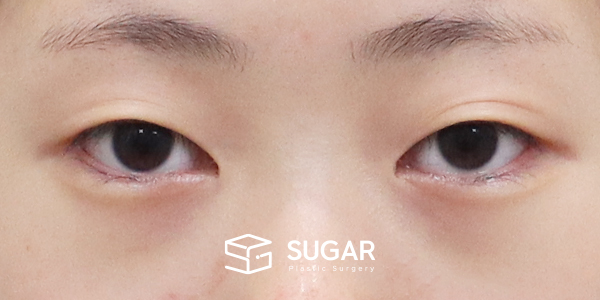 SUGAR整形外科 術前術後案例 #1212 術前術後照片 - 術前