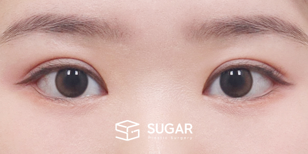 SUGAR整形外科 術前術後案例 #1272 術前術後照片 - 術後