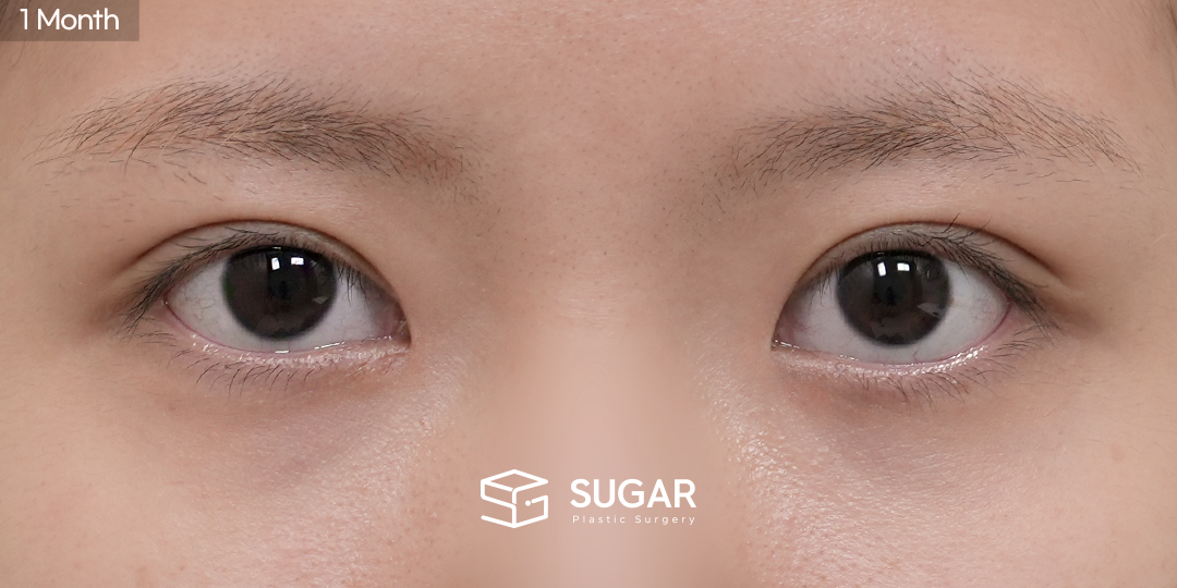 SUGAR整形外科 非切開提眼瞼肌矯正 + 開眼頭 術前術後照片 - 術後