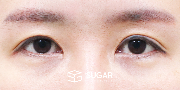 SUGAR整形外科 術前術後案例 #1441 術前術後照片 - 術前