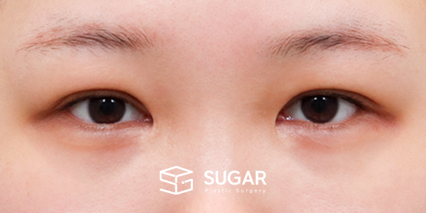SUGAR整形外科 術前術後案例 #1267 術前術後照片 - 術前