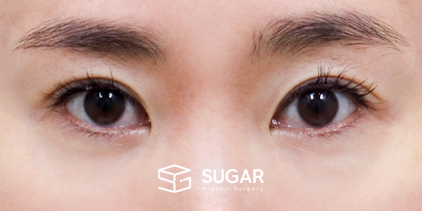 SUGAR整形外科 術前術後案例 #1270 術前術後照片 - 術前