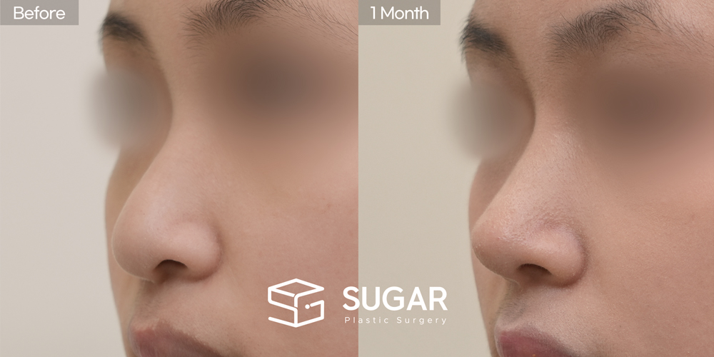 SUGAR整形外科 鼻樑 + 耳後筋膜 + 鼻尖 + 耳軟骨 + 鼻中膈 + 蒜頭鼻 + 長鼻縮短 術前術後照片 - 45度術前術後比較