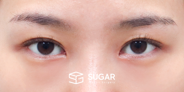 SUGAR整形外科 術前術後案例 #1280 術前術後照片 - 術後