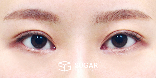 SUGAR整形外科 術前術後案例 #1443 術前術後照片 - 術後