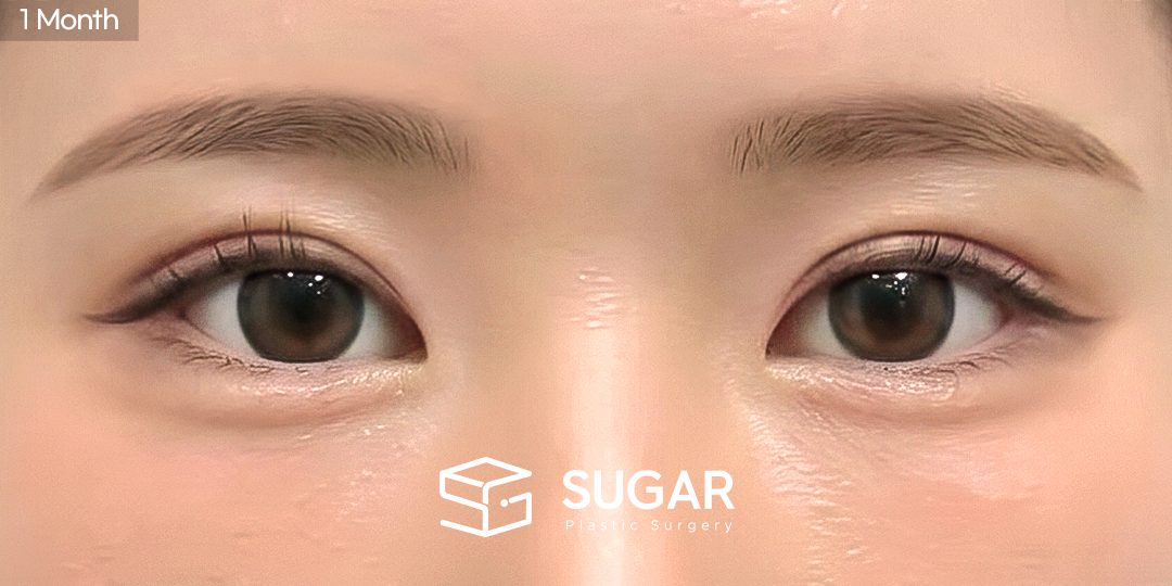 SUGAR整形外科 術前術後案例 #1568 術前術後照片 - 術後