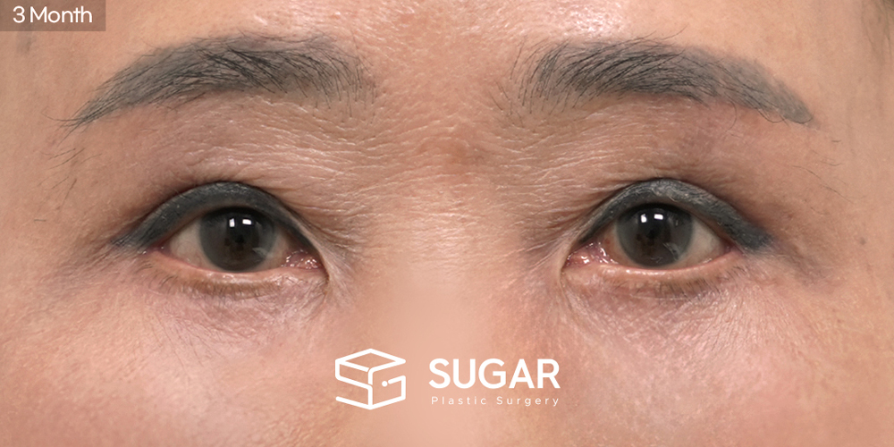 SUGAR整形外科 眉下提眉術 + 下眼瞼整形術 術前術後照片 - 術後