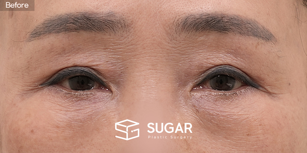 SUGAR整形外科 眉下提眉術 + 下眼瞼整形術 術前術後照片 - 術前