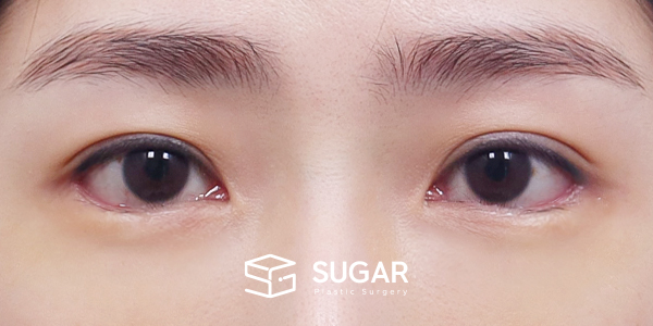 SUGAR整形外科 術前術後案例 #1287 術前術後照片 - 術後