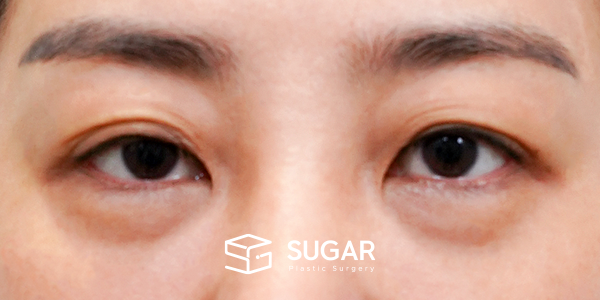 SUGAR整形外科 術前術後案例 #1178 術前術後照片 - 術前