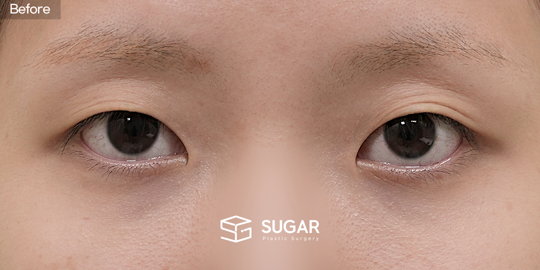 SUGAR整形外科 非切開提眼瞼肌矯正 + 開眼頭 術前術後照片 - 術前