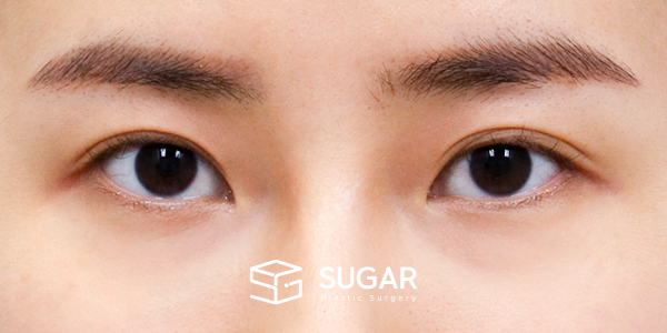 SUGAR整形外科 術前術後案例 #1182 術前術後照片 - 術前
