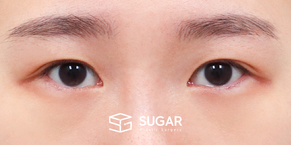 SUGAR整形外科 術前術後案例 #1185 術前術後照片 - 術前