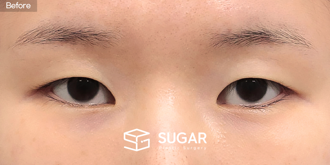 SUGAR整形外科 術前術後案例 #1568 術前術後照片 - 術前