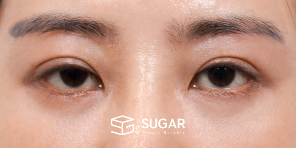 SUGAR整形外科 術前術後案例 #1178 術前術後照片 - 術後
