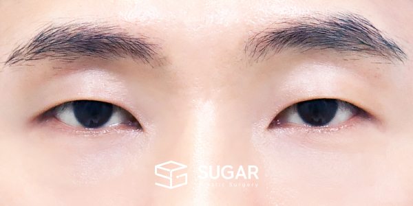 SUGAR整形外科 術前術後案例 #1432 術前術後照片 - 術後