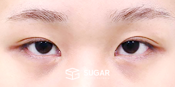 SUGAR整形外科 術前術後案例 #1449 術前術後照片 - 術前