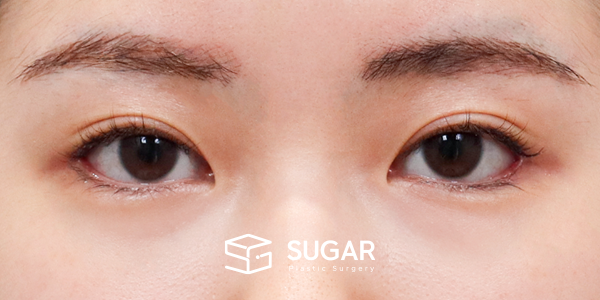 SUGAR整形外科 術前術後案例 #1183 術前術後照片 - 術後
