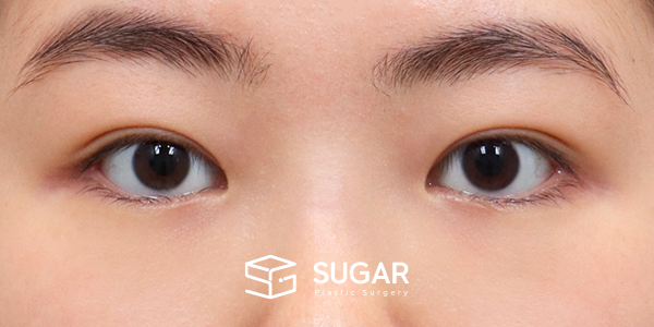 SUGAR整形外科 術前術後案例 #1177 術前術後照片 - 術後