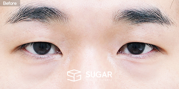 SUGAR整形外科 術前術後案例 #1477 術前術後照片 - 術前