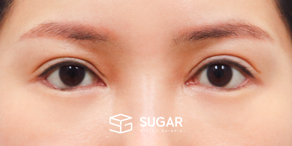 SUGAR整形外科 術前術後案例 #1262 術前術後照片 - 術後