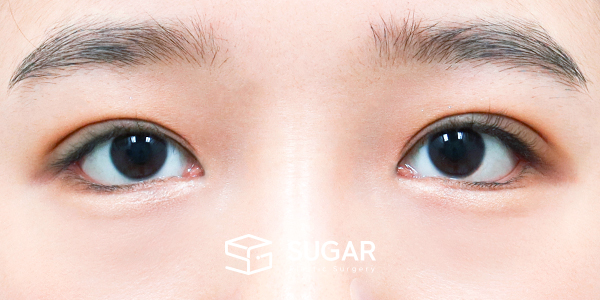 SUGAR整形外科 術前術後案例 #1439 術前術後照片 - 術後