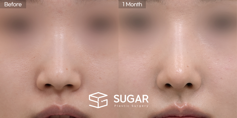 SUGAR整形外科 異體肋軟骨 + 耳軟骨 + 鼻樑 + 截骨 + 蒜頭鼻 術前術後照片 - 正面術前術後比較