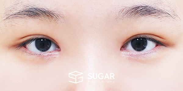 SUGAR整形外科 術前術後案例 #1453 術前術後照片 - 術後