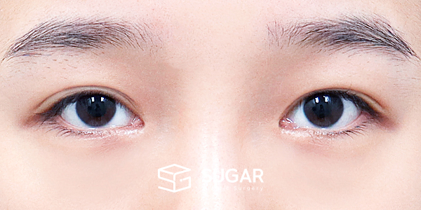 SUGAR整形外科 術前術後案例 #1439 術前術後照片 - 術前