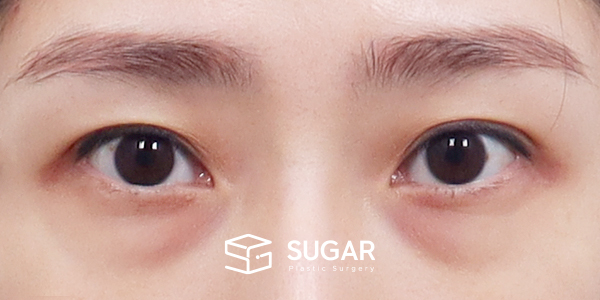 SUGAR整形外科 術前術後案例 #1287 術前術後照片 - 術前