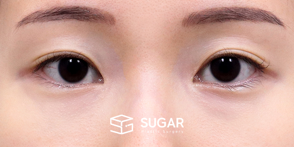 SUGAR整形外科 術前術後案例 #1181 術前術後照片 - 術前