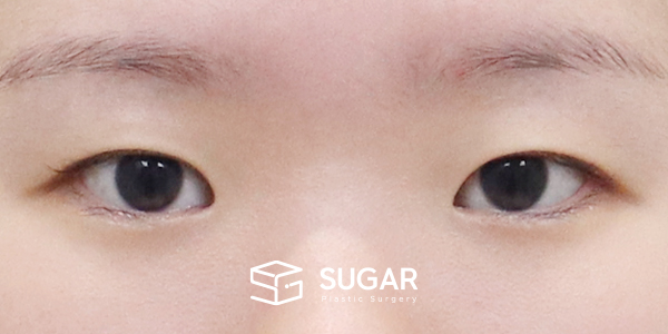 SUGAR整形外科 術前術後案例 #1272 術前術後照片 - 術前